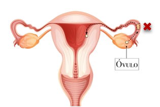 Imagem ilustrativa do artigo Como tratar obstrução nas trompas para engravidar