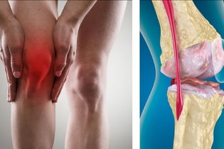 Illustrative image of the article Knee Arthritis: Symptoms, Diagnosis & Treatment Options