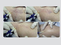 Imagen ilustrativa del artículo Escleroterapia con espuma: qué es, cómo se realiza y posibles riesgos