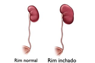 Imagem ilustrativa do artigo Rim inchado: o que pode ser, causas e tratamento