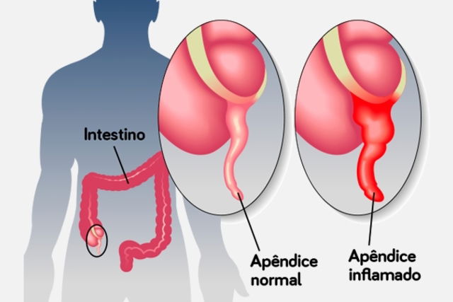 Image illustrative de l'article Appendicite: symptômes, causes et traitement