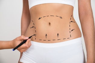 Imagem ilustrativa do artigo Abdominoplastia com lipo: como é feita, resultados e pós-operatório 