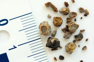 Illustrative image of the article Kidney Stones: Causes, Symptoms, Diagnosis & Treatment