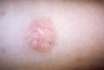 Illustrative image of the article Pityriasis Rosea: Causes, Symptoms, Diagnosis & Treatment