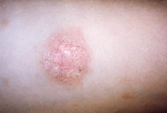 Illustrative image of the article Pityriasis Rosea: Symptoms, Causes & Treatment