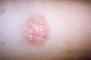 Illustrative image of the article Pityriasis Rosea: Causes, Symptoms, Diagnosis & Treatment