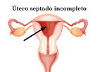 Imagem ilustrativa do artigo Útero septado: o que é, como identificar e tratamento