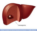 Illustrative image of the article Liver Hemangioma: Symptoms, Diagnosis & Treatment