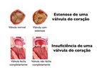 Imagem ilustrativa do artigo Valvuloplastia: o que é, tipos e como é feita