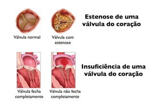 Imagem ilustrativa do artigo Valvuloplastia: o que é, tipos e como é feita