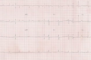 Imagen ilustrativa del artículo Electrocardiograma (ECG): qué es, cómo leerlo y para qué sirve