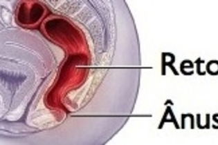 Imagen ilustrativa del artículo Prolapso rectal en niños: causas y tratamiento