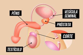 Imagem ilustrativa do artigo Vasectomia: o que é, como é feita e outras dúvidas comuns