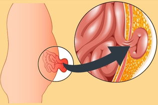 Imagen ilustrativa del artículo Hernia abdominal: qué es, síntomas, tipos y tratamiento