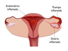Imagem ilustrativa do artigo Salpingite crônica: o que é, sintomas, causas e tratamento