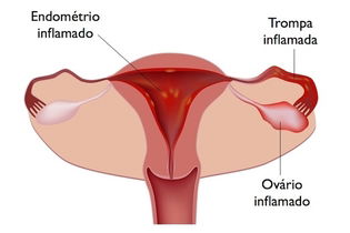 Imagem ilustrativa do artigo Salpingite crônica: o que é, sintomas, causas e tratamento