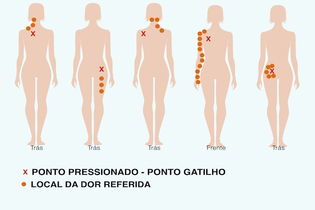 Imagem ilustrativa do artigo Como identificar a Síndrome Miofascial e como é feito o tratamento