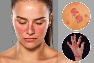 Illustrative image of the article What Are The Symptoms of Lupus? (& What Causes Them?)