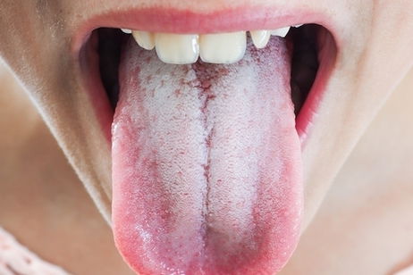 Illustrative image of the article White Tongue: 9 Causes & How to Get Rid of It