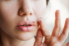 Illustrative image of the article How fast does acyclovir work for cold sores?