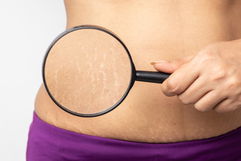 Imagem ilustrativa do artigo Estrias: o que são, tipos, causas, tratamento e como evitar