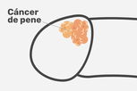 Imagen ilustrativa del artículo Cáncer de pene: 12 síntomas, causas y tratamiento