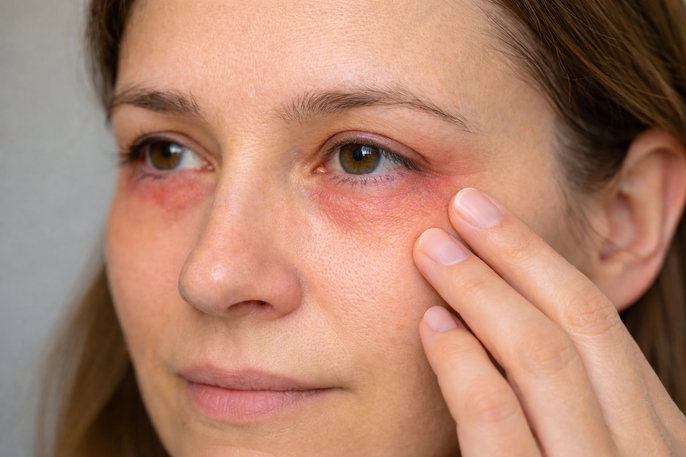 Woman with red under eyes | AI-generated image