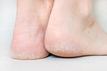 Illustrative image of the article Why Are My Feet Peeling? 8 Causes (w/ Pictures) & What to Do