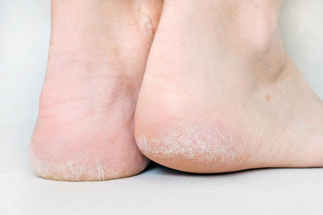 Illustrative image of the article Why Are My Feet Peeling? Top 5 Causes