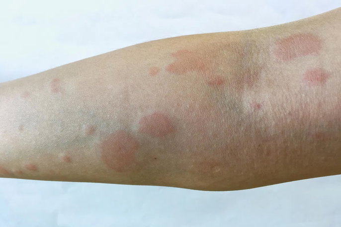 lupus