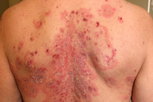 Illustrative image of the article Pemphigus Foliaceus: Symptoms, Causes & Treatment