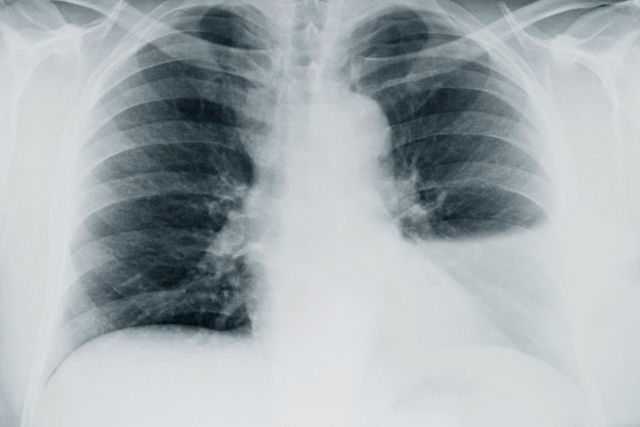 pleural effusion on chest x-ray