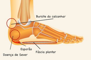 Illustrative image of the article Heel Pain: 7 Common Causes (& What to Do)