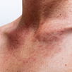 Illustrative image of the article Heat Rash: Symptoms, Causes & Treatment