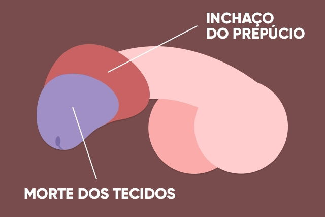 Ilustração da parafimose