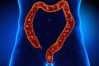 Illustrative image of the article Diverticulitis Treatment: Medications, Surgery & Diet