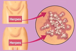 Imagem ilustrativa do artigo Transmissão do herpes genital: como se pega (e como evitar)