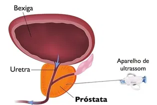 Imagem ilustrativa do artigo PSA total e livre: o que é, para que serve o exame e resultados