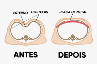 Imagem ilustrativa do artigo Peito escavado: o que é, sintomas, causas e tratamento