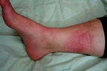 Illustrative image of the article Erysipelas: Symptoms, Causes & Treatment
