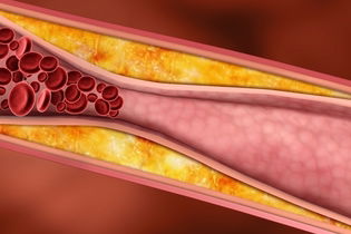 Image illustrative de l'article Différents types de cholestérol : LDL, HDL, VLDL et total