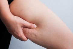 Imagen ilustrativa del artículo ¿Cómo quitar la celulitis rápido?