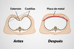 Imagen ilustrativa del artículo Pectus excavatum: qué es, causas y cómo corregirlo