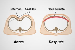 Imagen ilustrativa del artículo Pectus excavatum: qué es, causas y cómo corregirlo