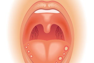 Illustrative image of the article Canker Sores: 7 Common Causes, How to Treat & Home Remedies