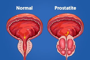 Imagem ilustrativa do artigo Prostatite: o que é, sintomas, causas e tratamento