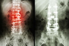 Imagen ilustrativa del artículo Espondilolistesis: qué es, síntomas y tratamiento