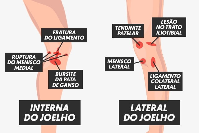 Dor no joelho: 11 causas comuns (e o que fazer) - Tua Saúde