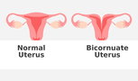 Illustrative image of the article Bicornuate Uterus: Symptoms, Causes & Treatment