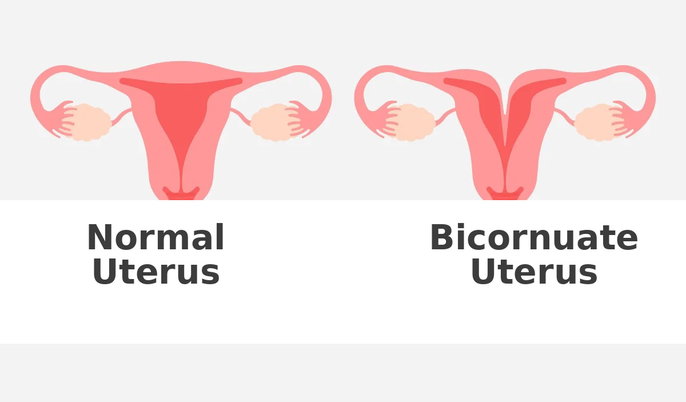 diagram of a normal uterus and a bicornuate uterus